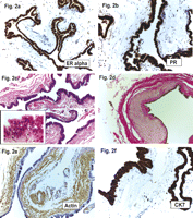 (a and b) The cyst epithelium showed strong nuclear positivity against estrogen receptor alpha, as well as against the progesterone receptor. The nuclei of the stromal cells, especially the smooth muscle cells, were completely negative for both ER and PR (ER alpha and PR; original magnification ×200). (c) The cyst almost had an extraordinarily thin wall with an almost completely circumferential smooth muscle layer (short arrows). With a higher magnification (insert HE; original magnification ×630) the ciliated epithelium is shown with regular round-to-oval nuclei without atypia and homogeneous cytoplasm of the cells. Focal formation of short pseudo-papillae is evident (long arrow) (H&E; original magnification × 200). (d) The smooth muscle layer is much more obvious and highlighted yellow with a van Gieson stain; as well as fibrous tissue stains red. Occasionally, the muscle layer is accentuated (arrow) with slight atrophy of the overlaying cuboidal epithelium (vG; original magnification ×200). (e) Immunohistochemistry underlines the circumferential smooth muscle layer; the walls of the small vessels (short arrow) stain positive as an internal positive control (Actin; original magnification ×200). (f) The luminal cyst epithelium was also strongly positive for cytokeratin 7 (CK7; original magnification ×400).