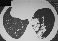 Chest computed tomographic scan revealing a giant bullae with soft tissue and fatty components, resembling a bunch of grapes.