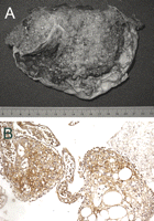 (A) Macroscopic appearance of the bullae, resembling a placenta. (B) Photomicrograph showing stromal cells strongly and consistently immunoreactive for CD-10 (×200).