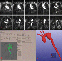 (a) Native coronal MRA images in DICOM format show the aortic arch aneurysm. (b) 3D image of the whole volume after segmentation by Maracas software. (c) Final 3D image after conversion to STL format.