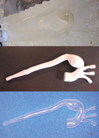 After reconstruction of the aorta by the stereolithography machine, the plaster-like reproduction of the vessel lumen was used to make a master mold (a). In (b) the mold is open, revealing the wax model. (c) Soft, transparent, plastic, life-size replica of the aneurysm made by the lost-wax technique.