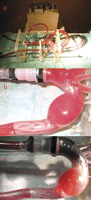 (a) Aortic arch aneurysm under extracorporeal circulation. (b) Stent deployment. (c) Absence of endoleak after methylin blue injection.