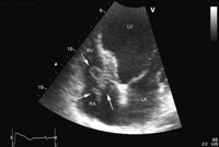 Echocardiography: apical cardiac four-chamber view with the large thrombus (arrows) on the cardiac defibrillator (Prizm VR1850, Guidant Inc.) lead across the tricuspid valve. RA: right atrium; RV: right ventricle: LA: left atrium; LV: left ventricle.