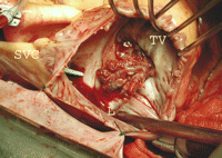 Intraoperative view of the thrombus across the tricuspid valve. Since insertion of the defibrillator, the patient was in sinus rhythm with anticoagulation therapy (fenprocoumon). SVC: superior vena cava; TV: tricuspid valve; L: lead of the cardiac defibrillator.