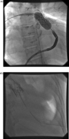 (a) Stent placed into calcified homograft. (b) Large left haemothorax with drains placed.