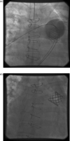 (a) Stent implanted in the RVOT. (b) Stent tilted obstructing the RVOT.