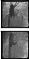 (a) Stent implanted in homograft with occlusion of LCA on aortic contrast injection. (b) Flow into LCA restored after cardiac massage.