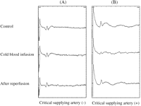 Changes in transcranial motor-evoked potentials (Tc-MEPs) following cold blood infusion. (A) Tc-MEPs without decrease to <50% of baseline during and after cold blood infusion. (B) Tc-MEPs with a decrease to <50% of baseline within 3 min after cold blood infusion.