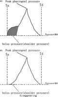 (a) Schematic diagram of a typical pharyngeal pressure tracing in the symptomatic patient of traditional hand-sewn group. Ta represents arrival of the bolus head; Td: completion of the pharyngeal-stripping wave. (b) Schematic diagram of a typical pharyngeal pressure tracing in the asymptomatic patient of side-to-side stapled group. Ta represents arrival of the bolus head; Td: completion of the pharyngeal-stripping wave.
