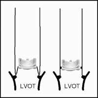 Schematic drawing of two technical options to construct a bioprosthetic valved conduit using a stented valve with creation of a sub-valvular Dacron skirt. LVOT, left ventricular outflow tract.