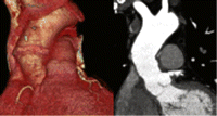 Late postoperative CT scan with three-dimensional reconstruction of a patient who had an ascending aortic replacement using Freestyle full-root plus Dacron graft extension technique.