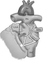 Left atrial ablation line includes isolation of the pulmonary veins and a connecting line performed between both islands of pulmonary veins on the roof, and a line from the left pulmonary veins to the posterior mitral annulus. The left atrial appendage was either amputated or sutured. Ao, aorta; PA, pulmonary artery; LPV, left pulmonary artery; RPV, right pulmonary artery; LAA, left atrial appendage; IVC, inferior vena cava.