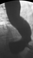 Barium swallow depicting an epiphrenic diverticulum. Preoperative manometry revealed significant tertiary contractions with intact primary peristalsis. The lower esophageal sphincter relaxed normally which excluded the diagnosis of achalasia.