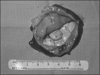 Resected diverticular sac demonstrating retained potassium supplementation pills. The patient had undergone a successful diverticulectomy, distal esophageal myotomy, and Belsey partial fundoplication through a left thoracotomy. There was minimal mucosal damage or peridiverticular inflammation as these were enteric coated pills. Following surgery, the patient’s hypokalemia resolved.