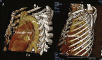 Three-dimensional image obtained from computed tomographic scan revealing a large feeding artery from the descending aorta, as well as a drainage vein to the lower pulmonary vein (A). Bifurcation of the artery from the descending aorta can be seen through the seventh intercostal space (B). Ao: descending artery; FA: feeding artery; ICS: intercostal space.
