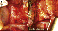 Intraoperative photograph. Large abnormal artery feeding the intralobar sequestration. The anatomical view during surgery was the same as the preoperative 3D-CT imaging. (A) The abnormal artery was clamped with a forceps, then divided and closed with running suture with two pieces of felt (B). S: divided stump of the feeding artery; LUL: left upper lobe; LLL: left lower lobe.