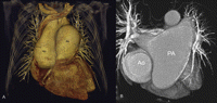 (A) Preoperative 64-slice computed tomography scan demonstrates both ascending aorta (Ao) and pulmonary artery (PA) dilatation. Ascending aorta – 7 × 8 cm in diameter; main pulmonary artery (PA) – 8.1 cm in diameter; right – 3.1 cm; left PA – 6.0 cm; (B) Cross sectional CT image shows both pulmonary artery branches dilatation, with dominant left pulmonary artery ectasia.