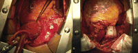 (A) With anulo-aortic ectasia and severe aortic insufficiency, pulmonary artery valve displasia and severe insufficiency, pulmonary artery ectasia, the patient underwent a surgical intervention. Ascending aorta (Ao) and pulmonary artery trunk (PA) were exposed by median sternotomy. (B) Ascending aorta aneurysm and aortic valve were replaced with bioprosthesis and Dacron conduit. Pulmonary artery trunk was open; another bioprosthesis and Dacron tube were used to replace the native valve and pulmonary trunk. Subsequently, the Dacron graft was sheltered by native pulmonary artery wall.