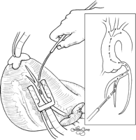 Octopus and Starfish™ devices were positioned. Cardiac arrest developed during the distal anastomosis to obtuse marginal artery. Last three sutures were inserted by blower assistance and then the devices were removed and internal cardiac massage was started. During the cardiac massage, massive air in all grafts and ascending aorta was noticed. Air was evacuated from grafts and ascending aorta by needle aspiration. But cerebral air embolism caused severe brain damage.