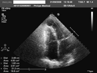 Two-dimensional echocardiogram demonstrating LV aneurysm (marked round-like area in an apex of LV).