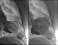 LV ventriculography showed apical LV aneurysm during the ventricular systole (on the left) and diastole (on the right). The patient was successfully operated and discharged on postoperative day 9.
