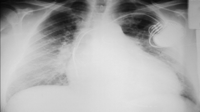 Chest roentgenogram showing a heart with idiopathic dilated cardiomyopathy and acute pulmonary oedema. Biventricular pacemaker was implemented for cardiac resynchronisation therapy.