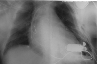 Chest roentgenogram immediately post implantation of a Jarvik 2000 LVAD through a left thoracotomy (LV apex-descending aorta) with a cardiac output of the left ventricle about 4.5 l showing regression of pulmonary congestion.