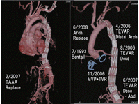 Reconstructed CT image shows implanted artificial valves in aortic and tricuspid position, mitral annuloplasty ring, vascular grafts in the aortic root, ascending arch and abdominal aorta and both common iliac arteries, and stent-grafts in the descending and supra-celiac abdominal aorta. All grafts are patent, and no leak or endoleak is observed.