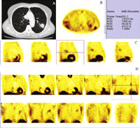 A 55-year-old woman with squamous cell carcinoma. CT scan shows primary tumor of the left upper lobe surrounded by normal lung tissue, and not greater than 3.0 cm in its largest diameter without evidence of hilar or mediastinal adenopathy (Part A). 99mTc-MIBI SPECT in transaxial view reveals good visualization of cancer. Drawing regions of interest (ROIs) over the tumor uptake (T) and in the controlateral normal side (N) is performed to calculate T/N ratio value (Part B). 99mTc-MIBI SPECT in sagittal (Part C) and coronal (Part D) views demonstrate area of increased abnormal uptake corresponding to lung cancer.