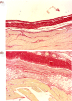 Sirius red staining. (A) KGF group with a minimal epicardial reaction, a scant non-compacted fibrous tissue creating the adhesion and a usual parietal pericardium with a standard pleural interface (×5). (B) Control group showing a epicardial reaction, the adhesion formed by a dense non-compacted fibrous tissue and a thickened parietal pericardium with a broad interface with the parietal pleura (×5).