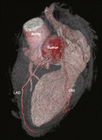 Cardiac CT scan reconstruction showing a round epicardial tumor, 45 mm × 42 mm, located at the level of the proximal left anterior descending artery (LAD) with extrinsic compression of the latter.