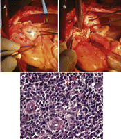 (A) Intraoperative view depicting the round epicardial encapsulated tumor, situated just anterior to the left appendage, to the left of the pulmonary artery and at the level of the left coronary artery bifurcation. (B) Intraoperative view showing the tumor dissected out of the cardiac muscle. The proximal LAD was completely inseparable from the tumor. (C) Histopathology view showing a large population of regular plasma cells with hyaline vascular hyperplasia (H&E stain, ×400). OM: obtuse marginal artery; PA: pulmonary artery trunk; Cx: circumflex coronary artery; LA: left appendage; RV: right ventricle.