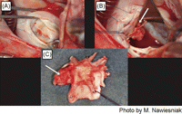 (A) Residual shunt on the spot of perforation. (B) Thrombus on the left atrial surface of the occluder. (C) Left atrial side of the occluder (arrows indicates the thrombus).