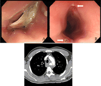 (A and B) Esophagogastroscopy shows the fish bone impacted in the esophagus and esophageal perforation (arrows). (C) Chest CT scan shows contrast leakage from the thoracic aorta.