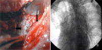 (A) Intraoperative picture shows the stent graft of aortic rupture (→) and retracted esophagus (↓). (B) Angiography shows the stent graft (32 mm × 10 cm, SEAL Thoracic stent graft, S&G BIOTEC INC.) in the aorta.