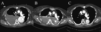 (A) Computed tomography scan shows a ruptured post-dissection thoracic aorta aneurysm. (B) The patient survived the acute period after endovascular stent grafting (28 mm). (C) Result after 18 months follow-up.