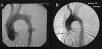 (A) Aortic angiogram demonstrates a ruptured type B aortic dissection with multiple entry tears. (B) Angiographic result after placement of a Talent stent graft.