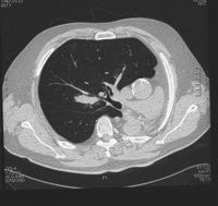 CT chest scan of the right upper pulmonary mass.