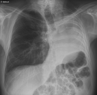 Chest radiography at 5-year follow-up. See the left-sided loss of volume with shift of the mediastinum and chest wall (ribs) and left hemidiaphragm towards the ‘empty’ left hemithorax.