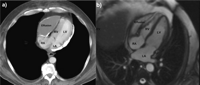Preoperative computed tomography (a) and dynamic cardiac magnetic resonance images using a steady state free precession sequence (b) demonstrating effusive constrictive pericarditis with a 2 cm anterior pericardial collection compressing the right ventricle and marked calcific thickening of the posterolateral pericardium surrounding the left ventricle. With RA: right atrium, RV: right ventricle, LA: Left atrium; LV: left ventricle.