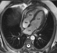 Postoperative dynamic cardiac magnetic resonance images demonstrating reduction of the pericardial collection and improved filling of the right ventricle following pericardiectomy. With RA: right atrium, RV: right ventricle, LA: left atrium, LV: left ventricle.
