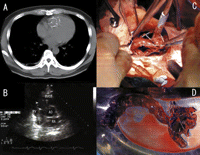 (A) Non-contrast computed tomography showing the filter migrated into the right ventricle (RV). (B) Transthoracic echocardiography demonstrating the filter (arrowhead) in the RV and the right ventricular outflow tract (RVOT). We were not able to perform an endovascular approach to remove filter out of the RV because of a big thrombus (arrow). (C) Intraoperating picture; a thrombus in the RV and the filter that extended into the RVOT. (D) Intraoperating picture; a giant thrombus and the filter removed from the RV and RVOT. This is an extremely rare type of an inferior vena cava filter migration with a giant thrombus, since endovascular approach can be successful in many cases and there is no report of a giant thrombus, such as this case.