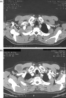 Pancoast tumour T3N0M0 right (a) before and (b) after radio-chemotherapy, access Shaw–Paulson, lobectomy, resection of the 1st to 3rd rib in combination with the transversal process and the 1st thoracic nerve root.