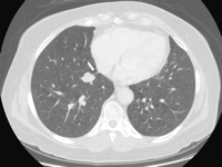 At CT scan, the typical aerated appearance of the accessory cardiac bronchus was not present due to proximal mechanical obstruction. Its presence may be only presumed by the pleural folding sign (arrow). Bronchoscopy, performed for the presence of hemoptysis, did not reveal any anatomical abnormality. Diagnosis of accessory cardiac bronchus was made only intra-operatively.