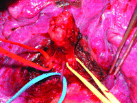 Anatomical structures of the accessory cardiac bronchus were isolated and separately ligated (artery: red, vein: blue, bronchus: yellow). Given the metastatic nature of the middle lobe nodule and the patient’s poor respiratory function, bilobectomy was not performed. Two years after surgery, no recurrence was recorded.