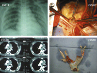 (A) The chest röntgenography. (B) The pulmonary artery CT angiography (transverse view) showed a whole filling defects in the main and both of the right and left pulmonary artery. (C) The thromboendarterectomy procedure. (D) An enlarged and organized thrombosis which extended from the pulmonary valve to both the right and left pulmonary artery and their branches was removed.