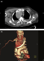 (a) CT chest at the time revealed a brachiocephalic trunk aneurysm extending from the origin of the arch of the aorta all the way up to the thoracic inlet area measuring in excess of 8 cm × 7 cm × 6 cm with evidence of surrounding thrombus and multiple lymph nodes in the pre- and peri-carinal area with the largest measuring 2.0 cm. (b) The trachea and oesophagus were compressed by the aneurysm and displaced to the left side (Fig. 2). This explained the hoarseness of voice and dysphagia for liquids and solid food in patient. The two working diagnoses were an underlying vasculitic process or a pre-existing aneurysm that became secondarily infected and rapidly expanded as per patient’s blood and urine that grew E. coli.
