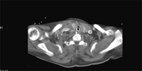 The aneurysm was isolated with bypass of Dacron graft and stenting (dark arrows). It was not drained at the time and 48 h later the patient had an episode of massive haemoptysis. CT scan demonstrated an aneurysmal tracheal fistula that leads to subsequent CT guided percutaneous drainage of the aneurysm. Patient recovered well.
