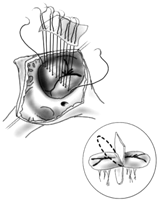 Figure illustrates double patch repair of AVSD. Notice the sutures extending through the bridging leaflets from within the ventricular patch (encircled inset). These sutures will then be passed through the pericardial patch to close the atrial septal defect (reproduced with the permission of CTSNet, Inc.).