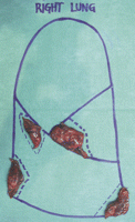 Intraoperative specimens.